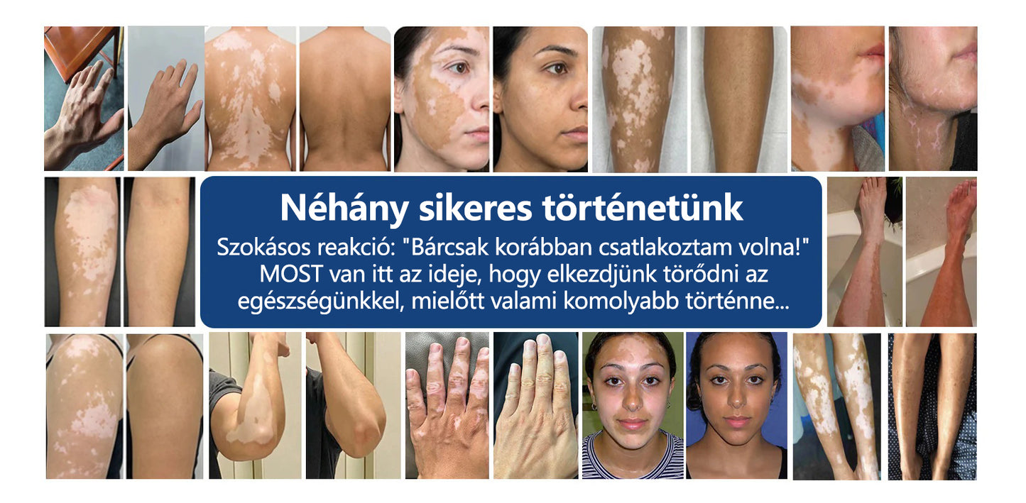 🌿CleraNaure® Piperine Repigment Aktivátor Spray, amely aktiválja a lappangó pigmentsejteket, és visszaállítja a természetes bőrszínt.