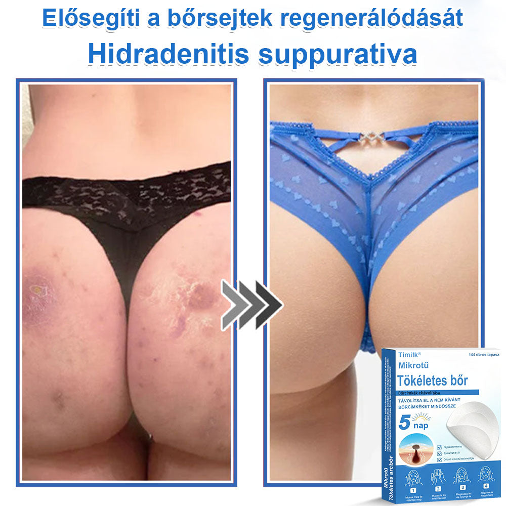 📌 Timilk® 2 az 1-ben mikrotűs és hidrokolloid tapasz | Kiemelkedő anyajegyek, pattanások, lapos szemölcsök és bőrkinövések eltávolítására | Segít javítani a ráncok, hegek és bőrhibák megjelenését | Láthatatlan pattanástapasz arcra és testre📌📌