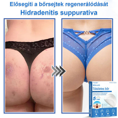 📌 Timilk® 2 az 1-ben mikrotűs és hidrokolloid tapasz | Kiemelkedő anyajegyek, pattanások, lapos szemölcsök és bőrkinövések eltávolítására | Segít javítani a ráncok, hegek és bőrhibák megjelenését | Láthatatlan pattanástapasz arcra és testre📌📌