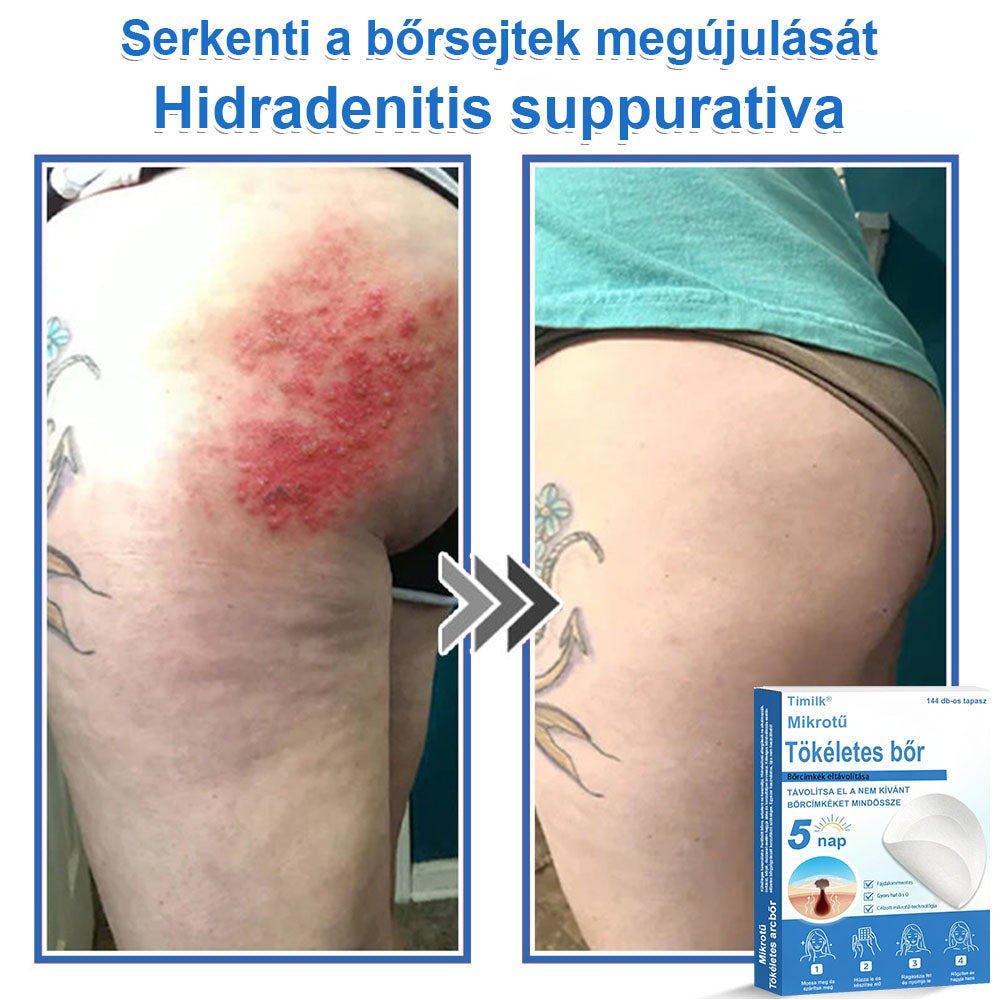 📌 Timilk® 2 az 1-ben mikrotűs és hidrokolloid tapasz | Kiemelkedő anyajegyek, pattanások, lapos szemölcsök és bőrkinövések eltávolítására | Segít javítani a ráncok, hegek és bőrhibák megjelenését | Láthatatlan pattanástapasz arcra és testre📌