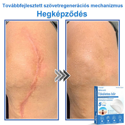 📌 Timilk® 2 az 1-ben mikrotűs és hidrokolloid tapasz | Kiemelkedő anyajegyek, pattanások, lapos szemölcsök és bőrkinövések eltávolítására | Segít javítani a ráncok, hegek és bőrhibák megjelenését | Láthatatlan pattanástapasz arcra és testre