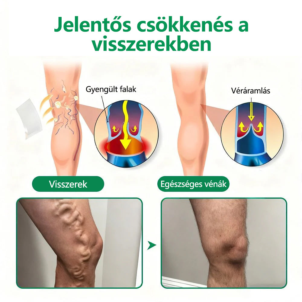 CleraNaure® VeinTarget Mikrotűs Pólya 🗽 Azonnali Enyhülés, Hosszú Távú Eredmények