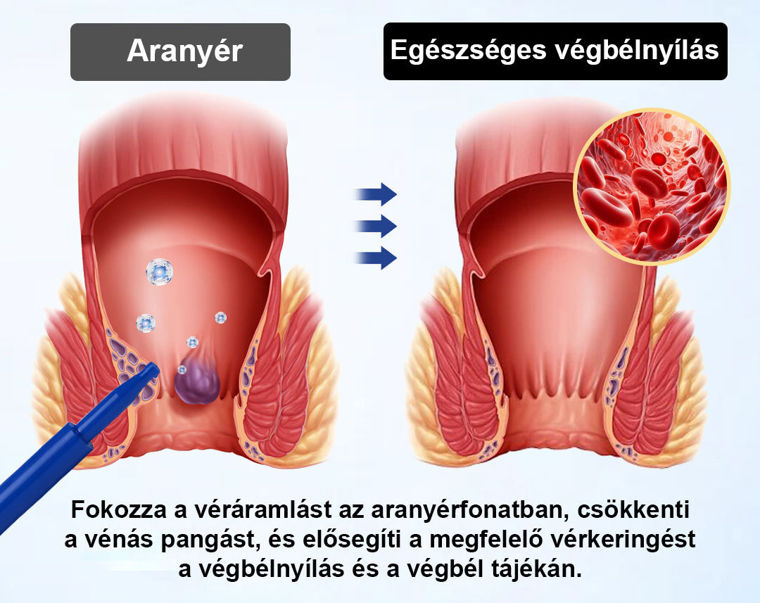 🌿🌿 Timilk® ProctoEase nyugtató aranyérápoló gél