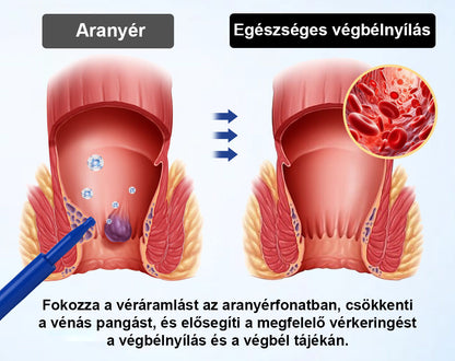 🌿🌿 Timilk® ProctoEase nyugtató aranyérápoló gél