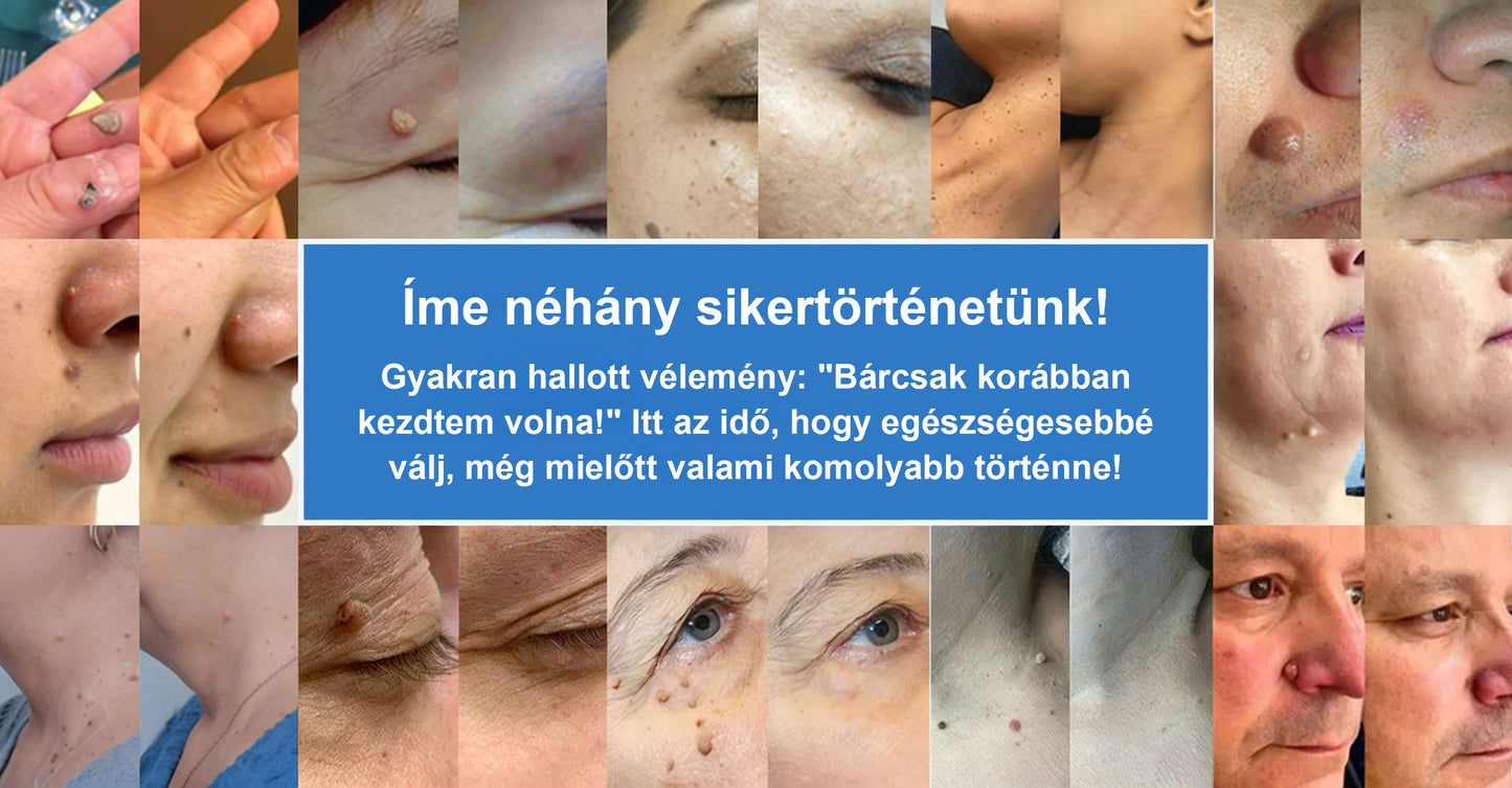 📌 Timilk® 2 az 1-ben mikrotűs és hidrokolloid tapasz | Kiemelkedő anyajegyek, pattanások, lapos szemölcsök és bőrkinövések eltávolítására | Segít javítani a ráncok, hegek és bőrhibák megjelenését | Láthatatlan pattanástapasz arcra és testre