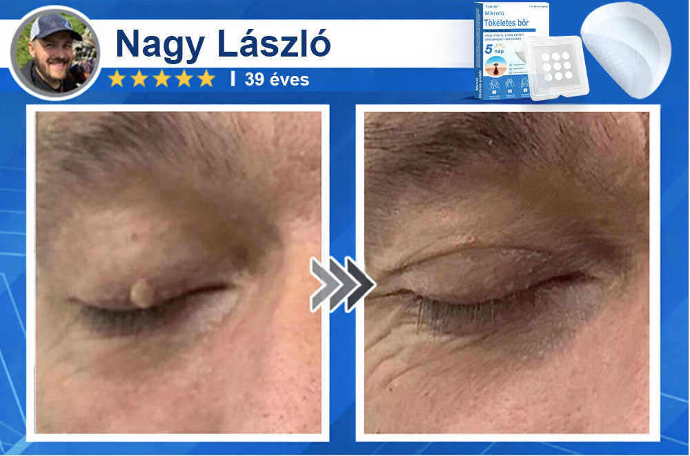 📌 Timilk® 2 az 1-ben mikrotűs és hidrokolloid tapasz | Kiemelkedő anyajegyek, pattanások, lapos szemölcsök és bőrkinövések eltávolítására | Segít javítani a ráncok, hegek és bőrhibák megjelenését | Láthatatlan pattanástapasz arcra és testre📌📌