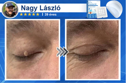 📌 Timilk® 2 az 1-ben mikrotűs és hidrokolloid tapasz | Kiemelkedő anyajegyek, pattanások, lapos szemölcsök és bőrkinövések eltávolítására | Segít javítani a ráncok, hegek és bőrhibák megjelenését | Láthatatlan pattanástapasz arcra és testre📌📌