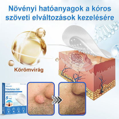 📌 Timilk® 2 az 1-ben mikrotűs és hidrokolloid tapasz | Kiemelkedő anyajegyek, pattanások, lapos szemölcsök és bőrkinövések eltávolítására | Segít javítani a ráncok, hegek és bőrhibák megjelenését | Láthatatlan pattanástapasz arcra és testre📌