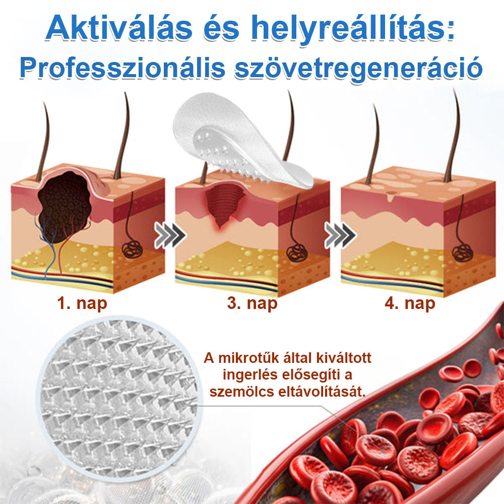 📌 Timilk® 2 az 1-ben mikrotűs és hidrokolloid tapasz | Kiemelkedő anyajegyek, pattanások, lapos szemölcsök és bőrkinövések eltávolítására | Segít javítani a ráncok, hegek és bőrhibák megjelenését | Láthatatlan pattanástapasz arcra és testre📌📌