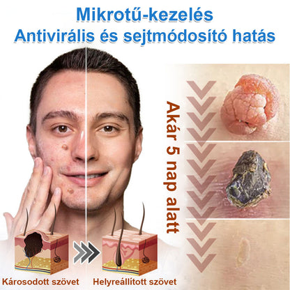 📌 Timilk® 2 az 1-ben mikrotűs és hidrokolloid tapasz | Kiemelkedő anyajegyek, pattanások, lapos szemölcsök és bőrkinövések eltávolítására | Segít javítani a ráncok, hegek és bőrhibák megjelenését | Láthatatlan pattanástapasz arcra és testre📌