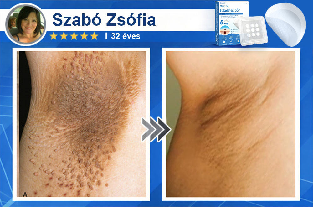 📌 Timilk® 2 az 1-ben mikrotűs és hidrokolloid tapasz | Kiemelkedő anyajegyek, pattanások, lapos szemölcsök és bőrkinövések eltávolítására | Segít javítani a ráncok, hegek és bőrhibák megjelenését | Láthatatlan pattanástapasz arcra és testre📌