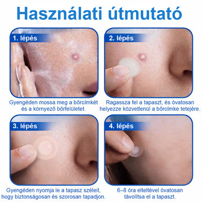 📌 Timilk® 2 az 1-ben mikrotűs és hidrokolloid tapasz | Kiemelkedő anyajegyek, pattanások, lapos szemölcsök és bőrkinövések eltávolítására | Segít javítani a ráncok, hegek és bőrhibák megjelenését | Láthatatlan pattanástapasz arcra és testre
