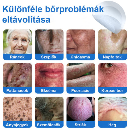 📌 Timilk® 2 az 1-ben mikrotűs és hidrokolloid tapasz | Kiemelkedő anyajegyek, pattanások, lapos szemölcsök és bőrkinövések eltávolítására | Segít javítani a ráncok, hegek és bőrhibák megjelenését | Láthatatlan pattanástapasz arcra és testre📌📌