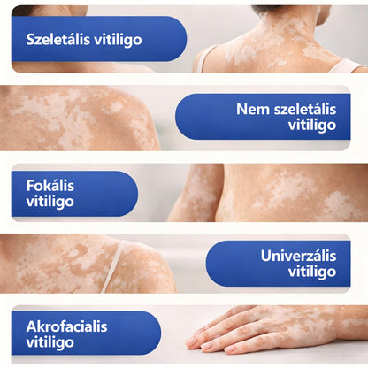 CleraNaure® Piperin Vitiligo újrapigmentáló permet – 🌿Szteroidmentes növényi összetétel | Kíméletes és hatékony minden bőrtípushoz