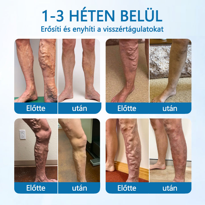 🪶CleraNaure® VeinGuard Gyógynövényes spray – ✅ Klinikailag bizonyított, hogy mindössze 7 nap alatt eltünteti a visszereket!🪶
