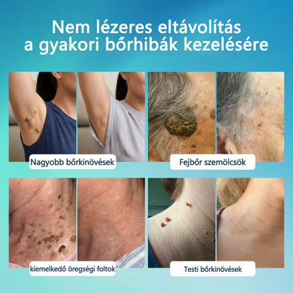 🖊 Timilk® SpotlessPro Fejlett Bőrápoló Toll 🖊