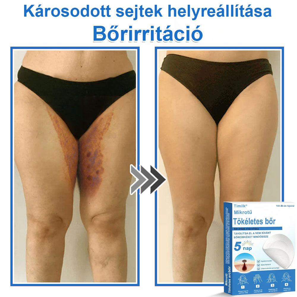 📌 Timilk® 2 az 1-ben mikrotűs és hidrokolloid tapasz | Kiemelkedő anyajegyek, pattanások, lapos szemölcsök és bőrkinövések eltávolítására | Segít javítani a ráncok, hegek és bőrhibák megjelenését | Láthatatlan pattanástapasz arcra és testre📌📌