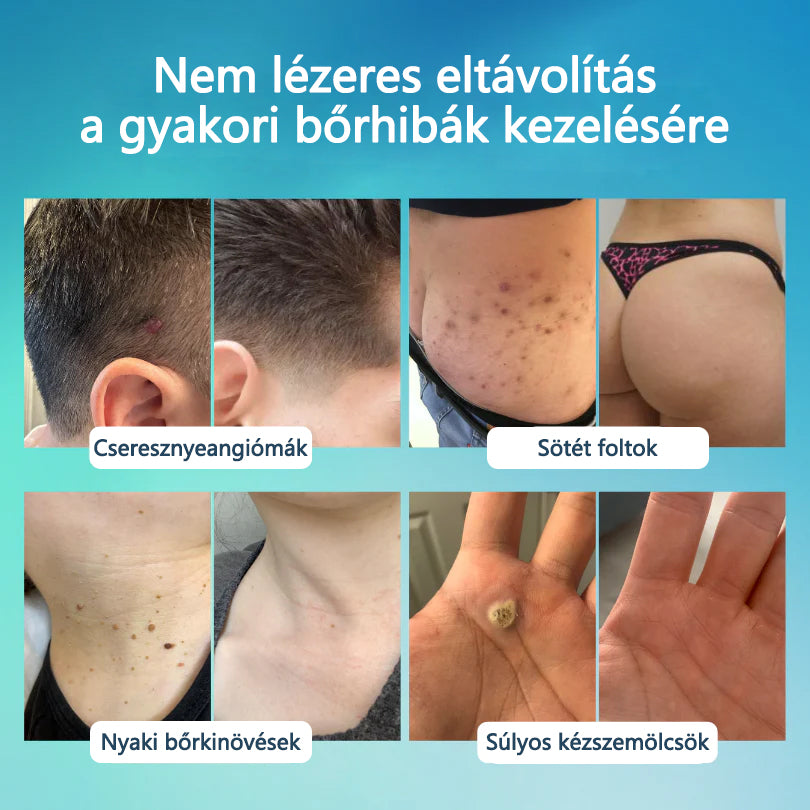 🖊 Timilk® SpotlessPro Fejlett Bőrápoló Toll 🖊