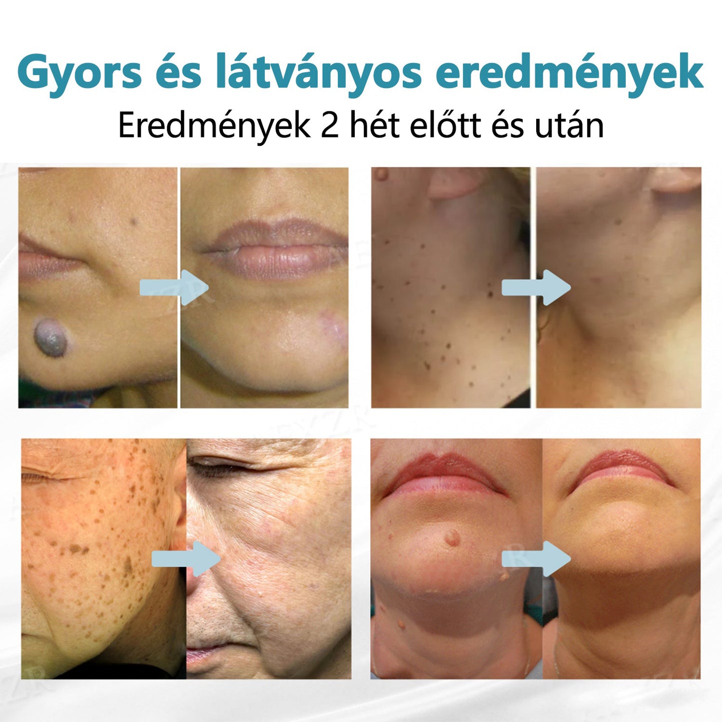 CleraNaure®  ajánlásával – non-invazív lézertoll szemölcsökre és anyajegyekre🔦🔦