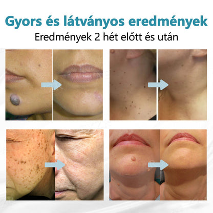 CleraNaure®  ajánlásával – non-invazív lézertoll szemölcsökre és anyajegyekre🔦🔦