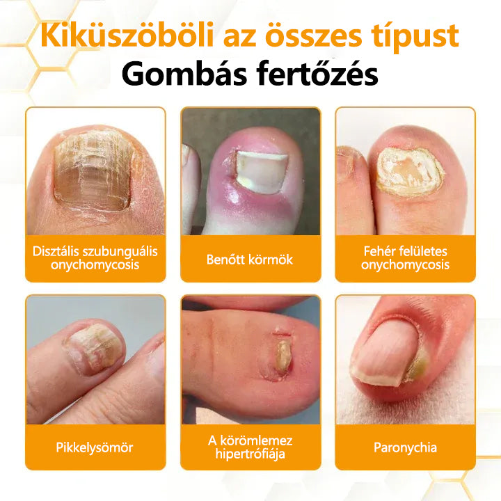 CleraNature® Antifungális Köröm Revitalizáló Olaj Méhméreggel