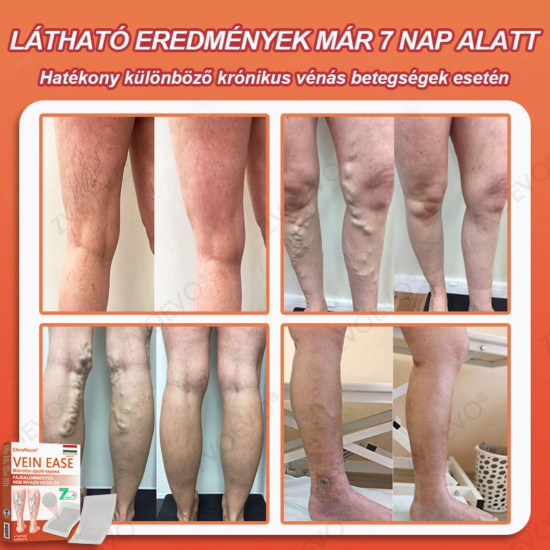 CleraNaure® Vein Ease Mikrotűs Kezelő Pecsét (Pókháló Vénák, Visszér, Duzzanat és Lábfáradtság Ellen)