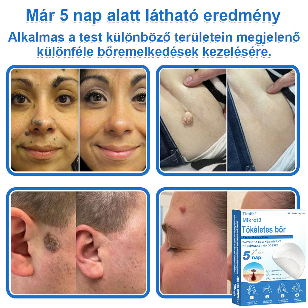 📌 Timilk® 2 az 1-ben mikrotűs és hidrokolloid tapasz | Kiemelkedő anyajegyek, pattanások, lapos szemölcsök és bőrkinövések eltávolítására | Segít javítani a ráncok, hegek és bőrhibák megjelenését | Láthatatlan pattanástapasz arcra és testre