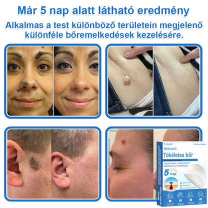📌 Timilk® 2 az 1-ben mikrotűs és hidrokolloid tapasz | Kiemelkedő anyajegyek, pattanások, lapos szemölcsök és bőrkinövések eltávolítására | Segít javítani a ráncok, hegek és bőrhibák megjelenését | Láthatatlan pattanástapasz arcra és testre