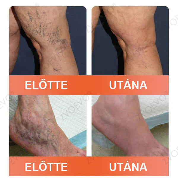 CleraNaure® Vein Ease Mikrotűs Kezelő Pecsét (Pókháló Vénák, Visszér, Duzzanat és Lábfáradtság Ellen)