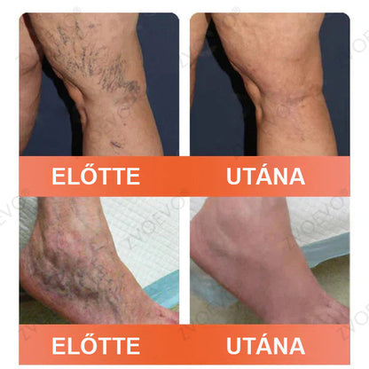 CleraNaure® Vein Ease Mikrotűs Kezelő Pecsét (Pókháló Vénák, Visszér, Duzzanat és Lábfáradtság Ellen)