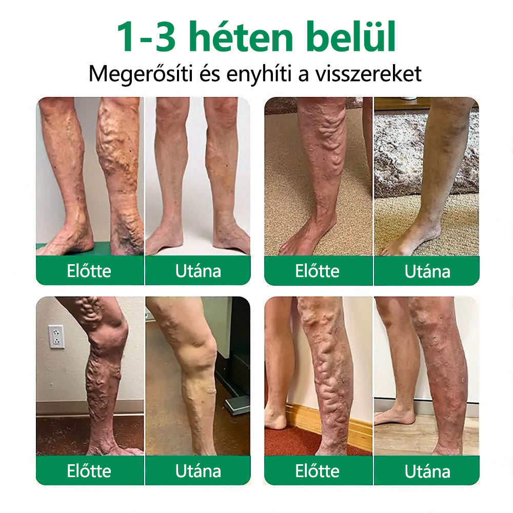 CleraNaure® VeinTarget Mikrotűs Pólya 🗽 Azonnali Enyhülés, Hosszú Távú Eredmények