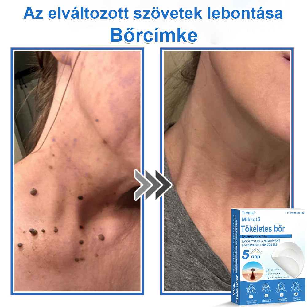 📌 Timilk® 2 az 1-ben mikrotűs és hidrokolloid tapasz | Kiemelkedő anyajegyek, pattanások, lapos szemölcsök és bőrkinövések eltávolítására | Segít javítani a ráncok, hegek és bőrhibák megjelenését | Láthatatlan pattanástapasz arcra és testre