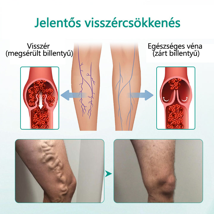 CleraNaure® LegRenew Visszértágulat Párna