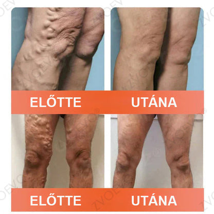 CleraNaure® Vein Ease Mikrotűs Kezelő Pecsét (Pókháló Vénák, Visszér, Duzzanat és Lábfáradtság Ellen)