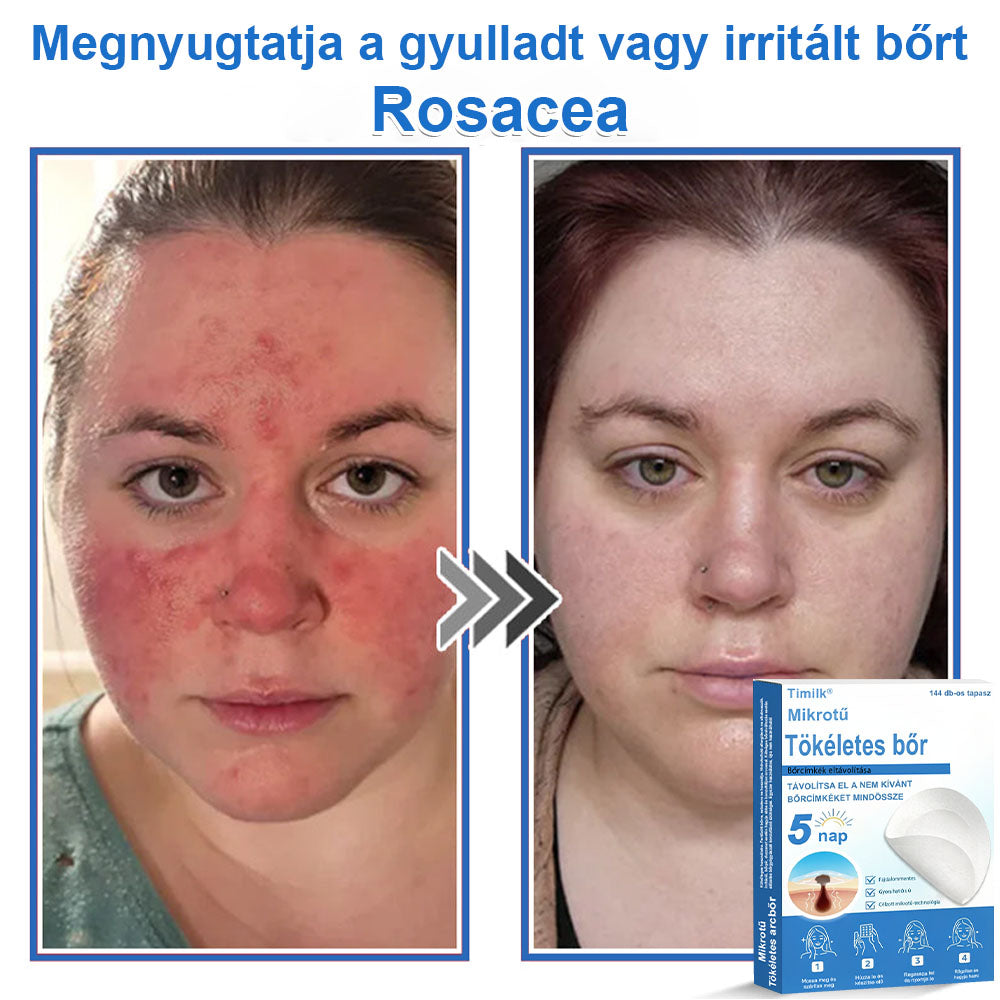 📌 Timilk® 2 az 1-ben mikrotűs és hidrokolloid tapasz | Kiemelkedő anyajegyek, pattanások, lapos szemölcsök és bőrkinövések eltávolítására | Segít javítani a ráncok, hegek és bőrhibák megjelenését | Láthatatlan pattanástapasz arcra és testre