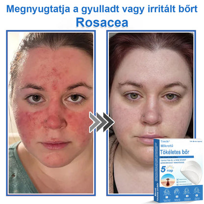 📌 Timilk® 2 az 1-ben mikrotűs és hidrokolloid tapasz | Kiemelkedő anyajegyek, pattanások, lapos szemölcsök és bőrkinövések eltávolítására | Segít javítani a ráncok, hegek és bőrhibák megjelenését | Láthatatlan pattanástapasz arcra és testre📌📌