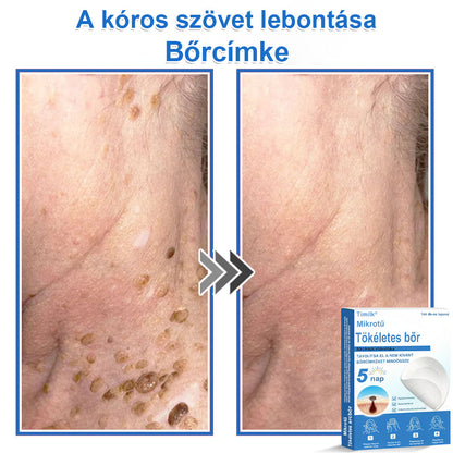 📌 Timilk® 2 az 1-ben mikrotűs és hidrokolloid tapasz | Kiemelkedő anyajegyek, pattanások, lapos szemölcsök és bőrkinövések eltávolítására | Segít javítani a ráncok, hegek és bőrhibák megjelenését | Láthatatlan pattanástapasz arcra és testre📌📌