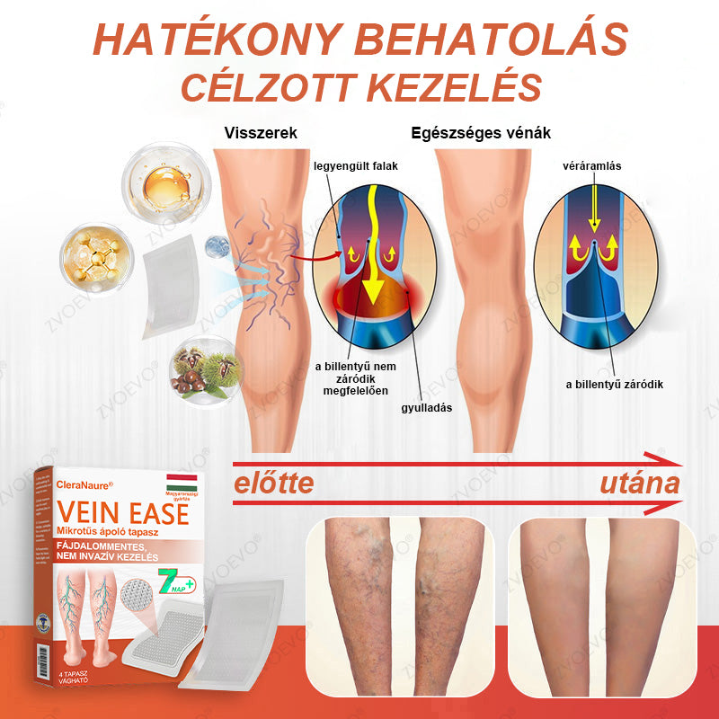 CleraNaure® Vein Ease Mikrotűs Kezelő Pecsét (Pókháló Vénák, Visszér, Duzzanat és Lábfáradtság Ellen)