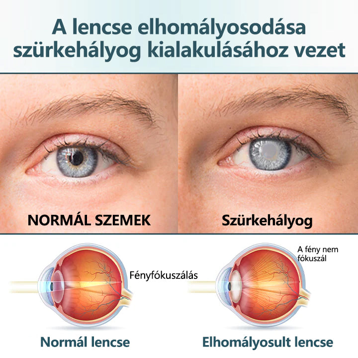 💎CleraNaure® Optifusion Nano Szemcsepp Szérum-A nanotechnológia visszaállítja a tiszta látást, szemüveg nélkül, műtét nélkül