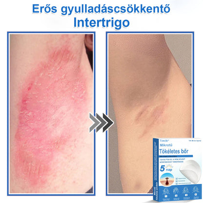 📌 Timilk® 2 az 1-ben mikrotűs és hidrokolloid tapasz | Kiemelkedő anyajegyek, pattanások, lapos szemölcsök és bőrkinövések eltávolítására | Segít javítani a ráncok, hegek és bőrhibák megjelenését | Láthatatlan pattanástapasz arcra és testre📌